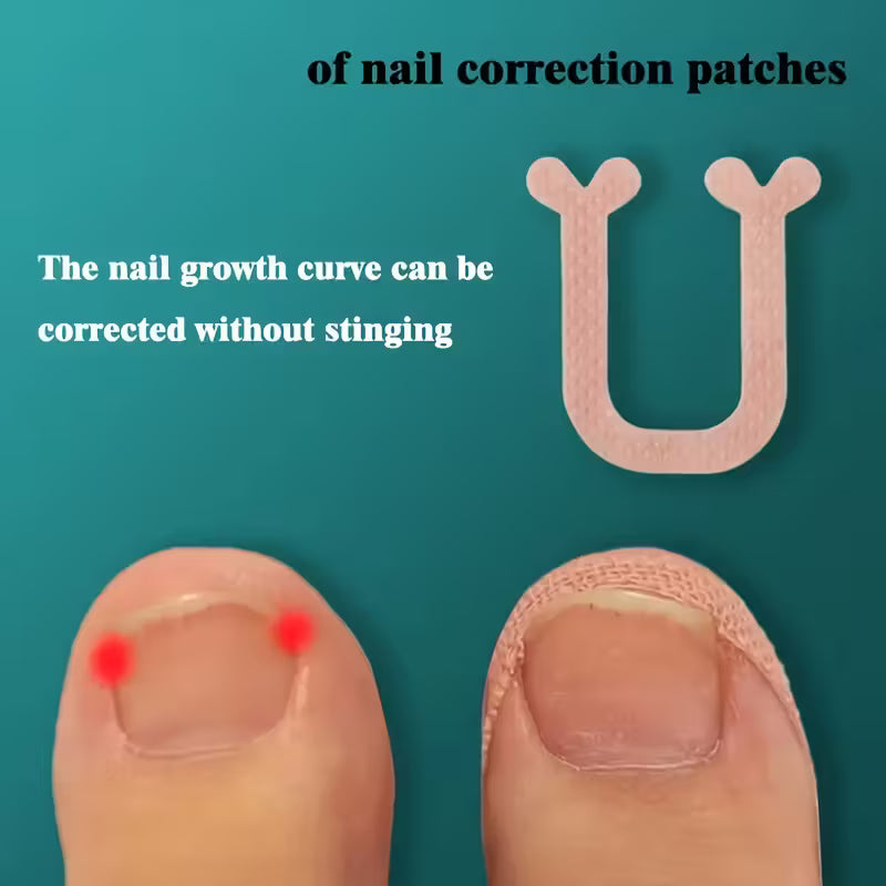 40 stk. U-formede negle plaster (indgroede negle)